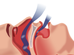 Obstructive Sleep Apnea is a genuine condition